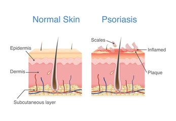 Normal skin layer and skin when plaque psoriasis signs and symptoms appear. illustration about dermatology diagram. - obrazy, fototapety, plakaty