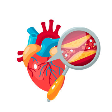 Coronary Artery Disease Concept In Flat Style