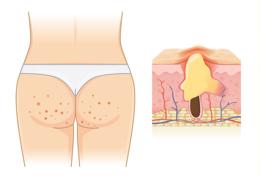 Pimples on buttocks and skin layer with acne isolated on white. Illustration about Dermatology.
