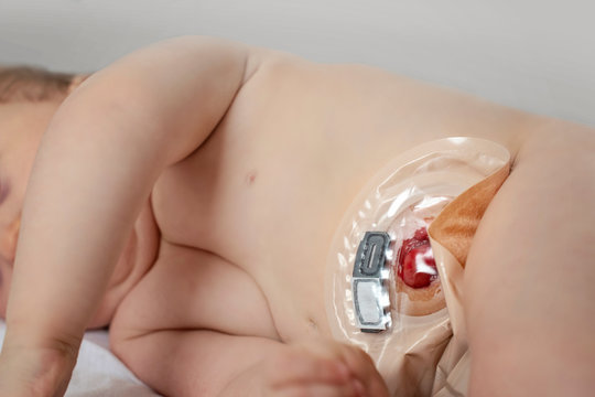 view on colostomy pouch attached to baby patient close-up, medial theme - image