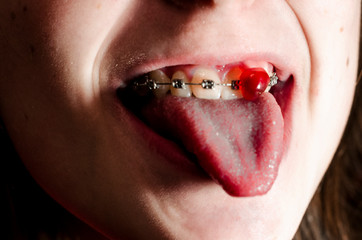 Pomegranate seed in the teeth braces