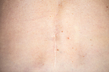 Scar on the back of an old caucasian woman after a spinal stenosis surgery