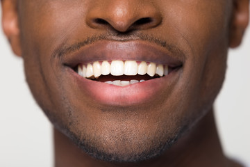 Close up view of beaming orthodontic white wide male smile, african black man with healthy straight...