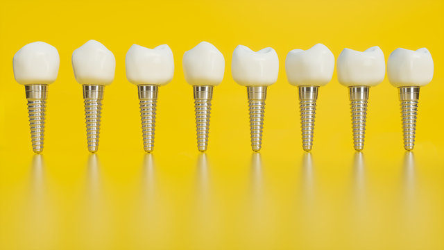 Tooth human implant. Human teeth or dentures on yellow background - 3d rendering