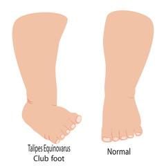 Darstellung - Klumpfuß im Vergleich zu Normalen Fuß