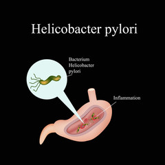 Helicobacter pylori in the stomach. Infographics. Vector illustration