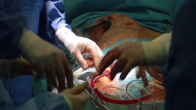 Team of cardiovascular surgery doctor in surgery center for interventions with instruments in surgeon operation with thoracotomy microsurgery doing minimal invasive open heart surgery