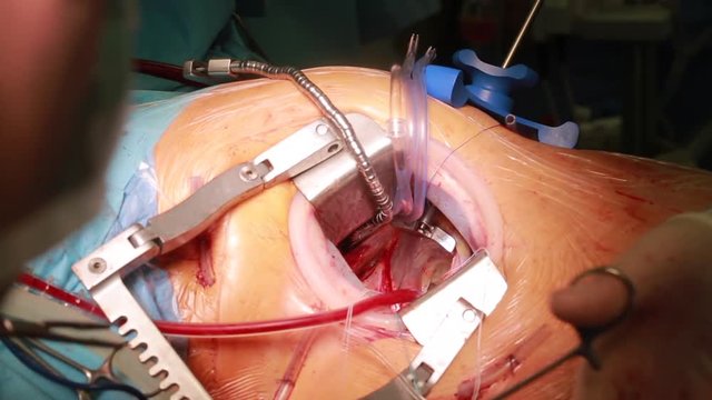 Closeup of surgeon hands doing minithoracotomy live beating open heart surgery