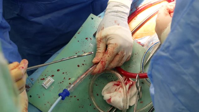 Close up of open heart surgery cardiopulmonary bypass, minimal invasive cardiac surgery, cannulation techniques. Minimally invasive mitral surgery through mini-thoracotomy with cannula tube