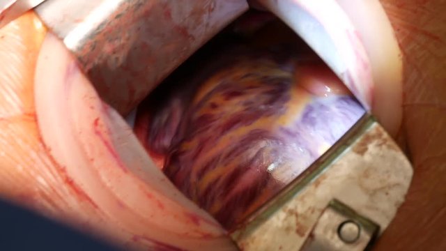 Close up of cardiovascular surgery doctor in surgery center for interventions with instruments in surgeon operation electrosurgery with thoracotomy microsurgery doing heart surgery
