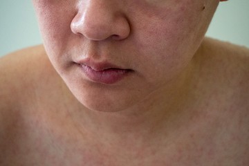 An exanthem is a rash or eruption on the skin. 