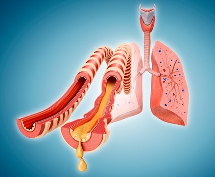 Normal and infected lung bronchi, illustration
