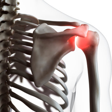 Illustration of a painful shoulder joint