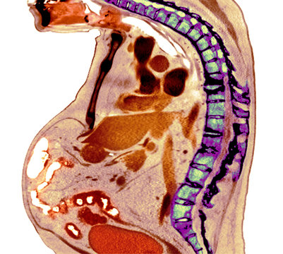 Spine in ankylosing spondylitis, X-ray