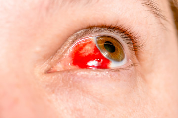 Subconjunctival hemorrhage - hyposphagma. Closeup of woman's face showing red bloodshot eye with...
