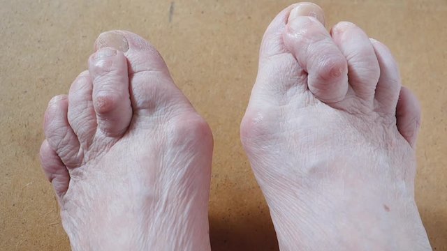 Valgus Deformity of Female Leg Due (Hallux Valgus) and Weakness of Ligaments.