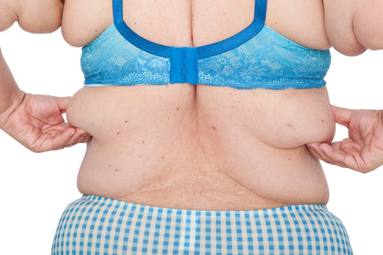 Middle aged woman with sagging excess arm skin after extreme weight loss. Before brachioplasty, panniculectomy, abdominoplasty and mummy makeover. Back view holding exces skin.