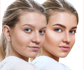 Young woman before and after skin treatment and makeup.