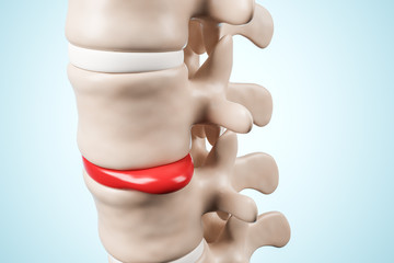 Human spinal system problem concept. Disk spain degradation. 3d rendering. - obrazy, fototapety, plakaty
