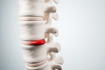 Human spinal system problem concept. Thinning disk spain degradation. 3d rendering.