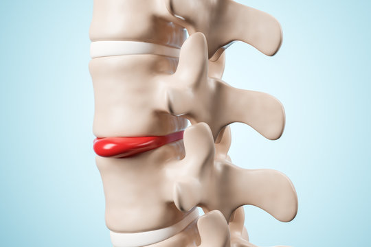 Human spinal intervertebral hernia. Disk spain degradation. 3d rendering.
