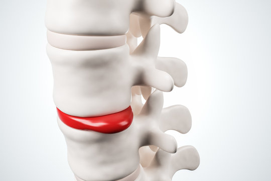 Human spinal intervertebral hernia concept. Disk spain degradation. 3d rendering.