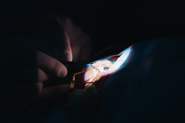 Retinal surgery. Ophthalmic eye surgery