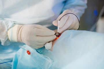 Ophthalmic surgery. Retinal. Surgeon's hands in gloves performing laser eye vision correction