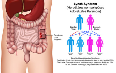 Lynch - Syndrom Vektor Illustration mit Erbfolge Beschreibung