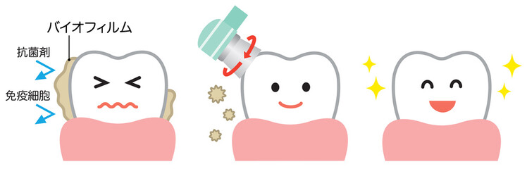 バイオフィルム除去　ビフォア　アフター