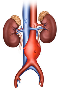 Ilustraci&oacute;n de aneurisma a&oacute;rtico abdominal
