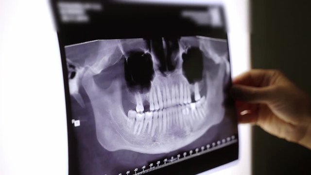 X-ray film of teeth and jaw. Doctor watching in hospital