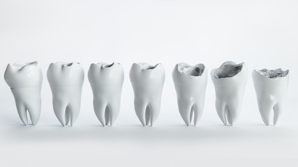 The stages of caries on the molar - 3D Rendering