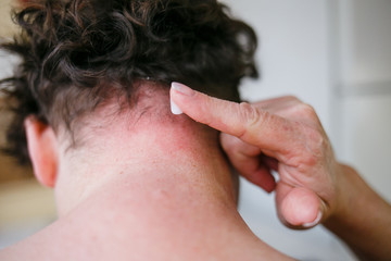 Woman hands lubricate damaged skin on the neck by healing ointment. Treatment for psoriasis skin. Allergic concept.