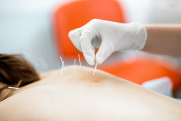 Close-up of the acupuncture medical treatment with special needles
