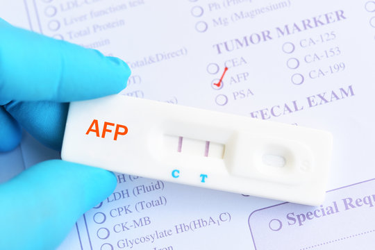 AFP positive test result by using rapid test cassette, liver cancer diagnosis