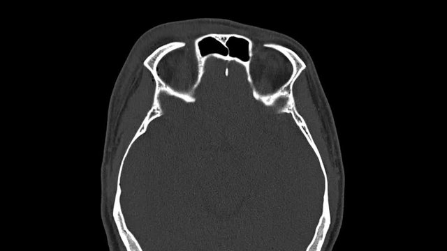 CT X-ray Scan on Human Brain fracture orbit.