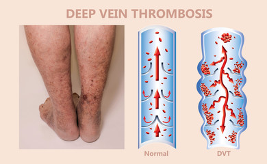 Economy class syndrome mechanism, deep vein thrombosis or DVT, Pulmonary Embolism, coronary thrombosis, diagram