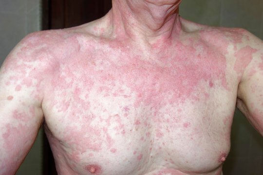 Man, 68 years old, with allergic reaction, skin rash, allergy, to insect repellent Baygon, Indonesia, Asia