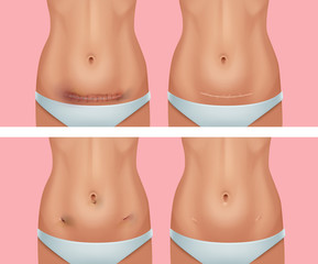 Vector set of fresh and healed scars on body after abdomen, wound from appendicitis removal surgery on background