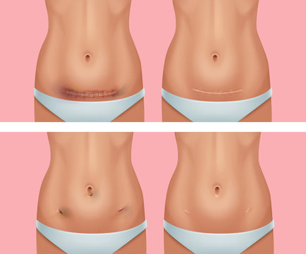 Vector set of fresh and healed scars on body after abdomen, wound from appendicitis removal surgery on background