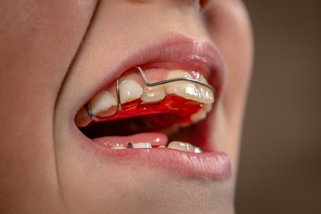 A kids open mouth showing an orthodontics corrective apparatus, side picture