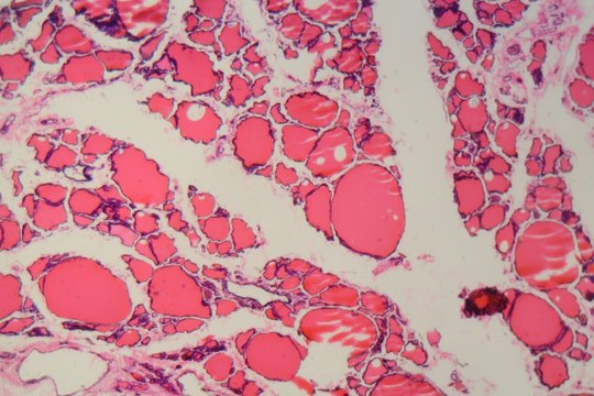Human thyroid gland with goiter caused by deficiency of iodine under a microscope