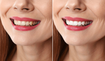 Smiling woman before and after teeth whitening procedure, closeup
