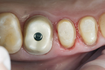 the basis for the installation of ceramic Dental Crowns
