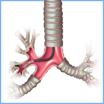 Examen para enfermedades pulmonares