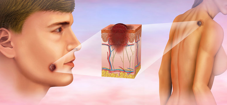 Melanoma en espalda y cara, ilustraci&oacute;n