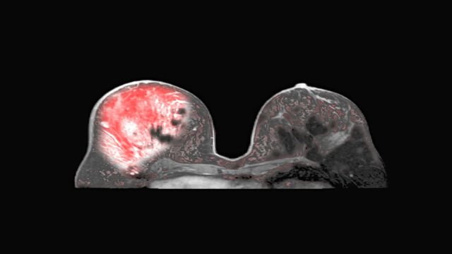 Breast Cancer Diagnosis Medical MRI Scan Monitor