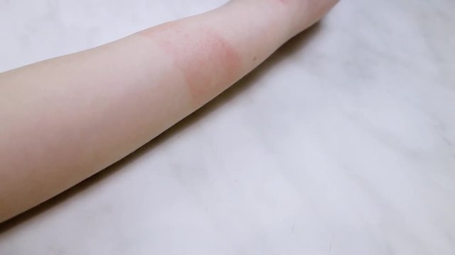 Irritation on the hand of a child caused by wearing an allergen bracelet.