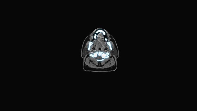 CT Scan Brian, MRI Monitor with Scan image of Head